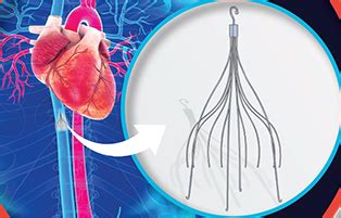 Medicininio IVC filtro schema